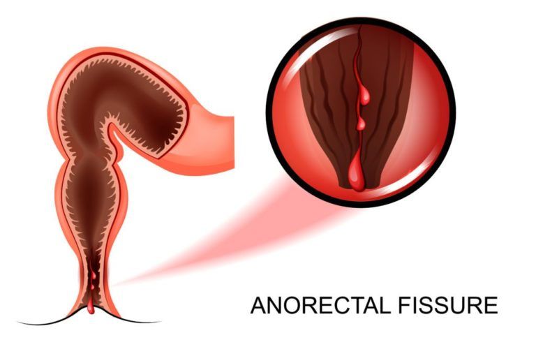 Anorectal Fissure  Andover Surgical Associates - Surgeons -5438